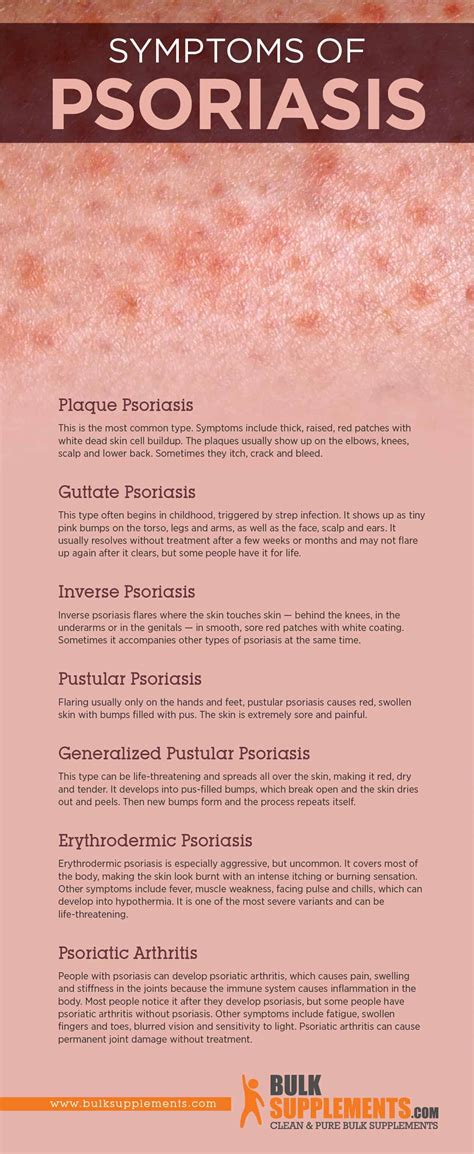 Psoriasis Symptoms Treatment And Causes - Infoupdate.org