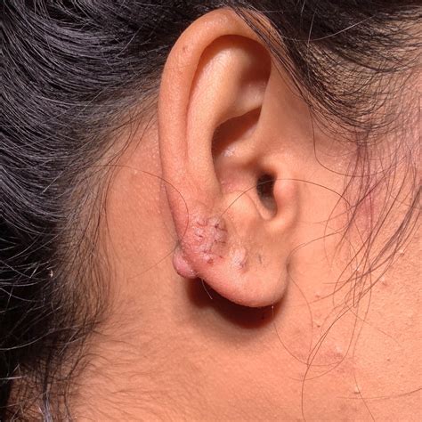 understanding earlobe keloid treatment removal options