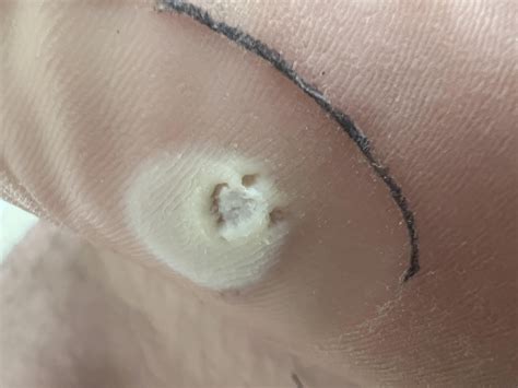 It finally happened. Looks like it’s gone. : r/Warts