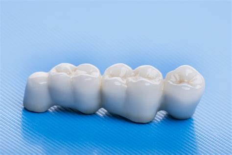 Dental Bridge: Types and Uses - Carolina Smiles Family Dental Brevard ...