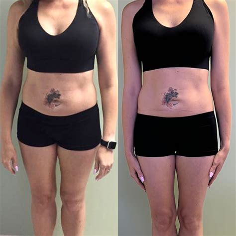 Before & After Gallery – Slim Me