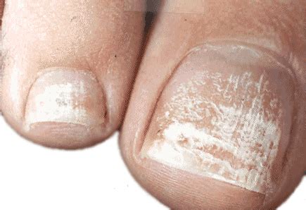 Top 11 Toenail Fungus Natural Treatments Using Home Remedy