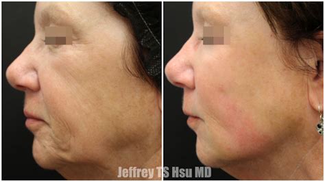 BeautiFill Jowls Before & After - LookYounger.News
