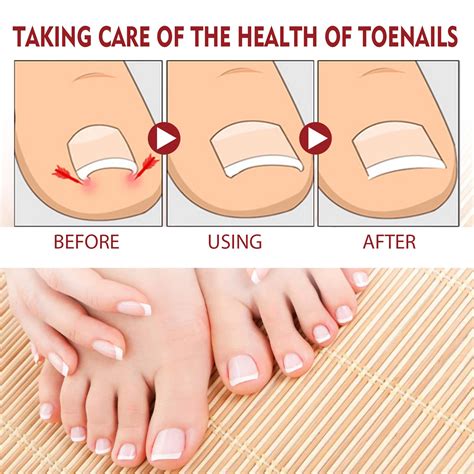 Jaysuing Anti Paronychia Relief Oil Toe And Fingernail Repair For