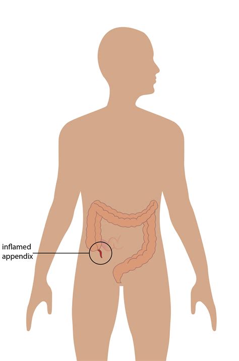 How Can Your Appendix Burst