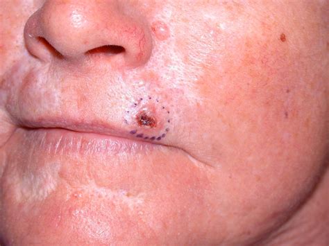 ACD A-Z of Skin - Basal Cell Carcinoma (BCC)
