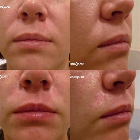 Носогубные складки — vzbeauty.ru