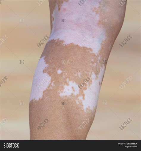 White Spots On Foot. Image & Photo (Free Trial) | Bigstock