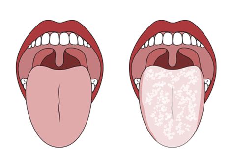Treating an Oral Thrush Infection and Preventing Future Episodes ...