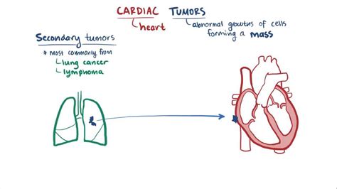 Myxoma: What Is It, Causes, Diagnosis, Treatment, and More | Osmosis