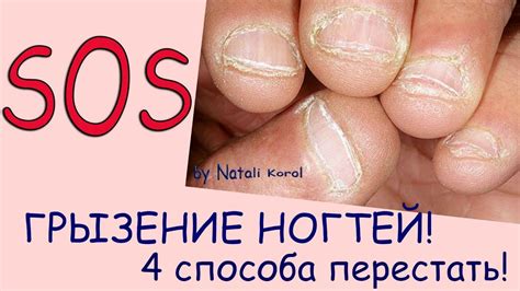 Вредные привычки / Как перестать грызть ногти - YouTube