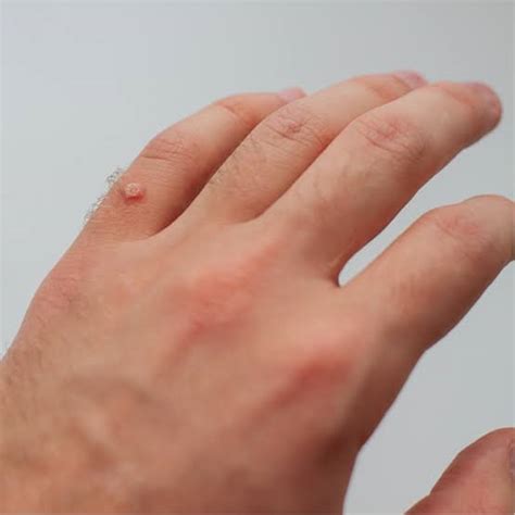 Warts