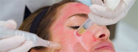 PRP Skin Treatment with Microneedling - Dr. Niketa Sonavane