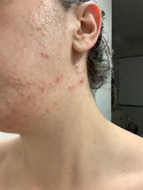 31 year old female – bacterial acne or fungal? (pictures) – General ...