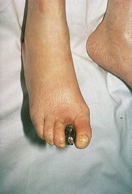 Fournier S Gangrene Pictures