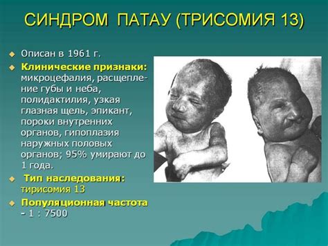Синдром Патау: причины, проявление и лечение