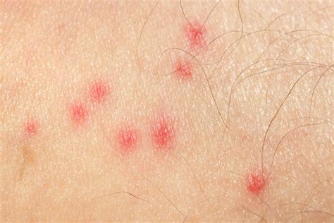 Bug Bite & Spider Bite Treatment at Midwest Express Clinic
