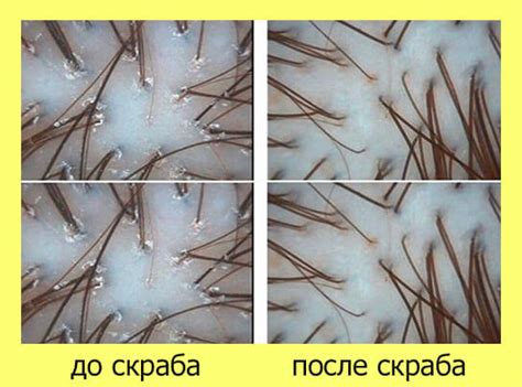 Домашний скраб для кожи головы: рецепт как сделать, как использовать