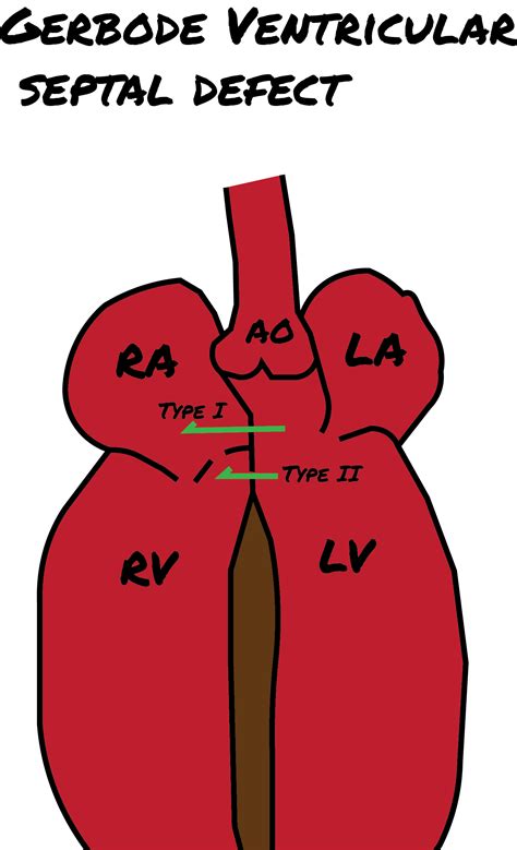 Ventricular Septal Defect Types Septal Congenital Heart Defects