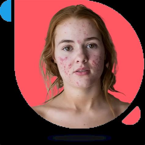 Women's Acne: Effective Solutions and Skincare Tips | The CareMD
