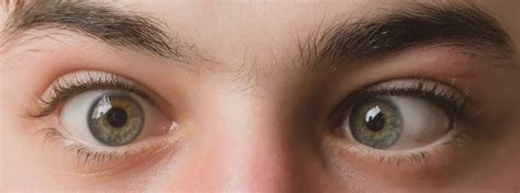 strabismus overview  symptoms treatment illnesscom