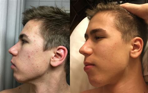 Accutane Tattoos