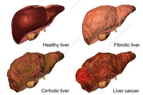 Liver Cirrhosis Stages