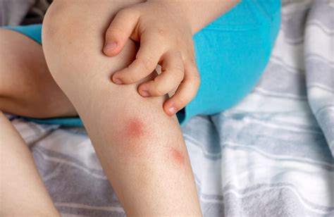 Understanding Eczema Rash in Babies - BLDG Active