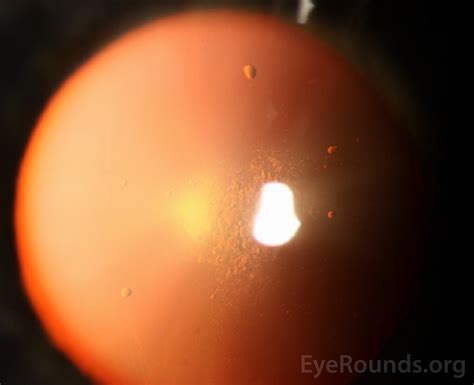 Atlas Entry - Posterior subcapsular cataract