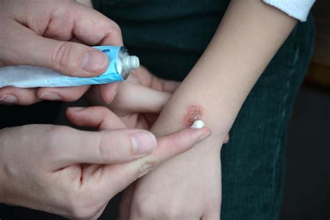 What Causes Scarring In Burns: Unveiling The Skins Healing Process
