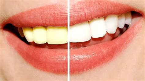 Como Ter Dentes Brancos - Como ter dentes mais brancos? - Rozante Odontologia