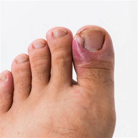 Say Goodbye to Ingrown Toenails: Essential Tips for Prevention