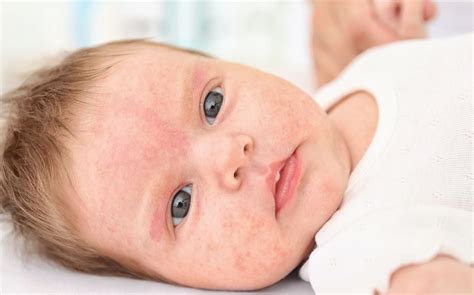 Alergia Ao Calor Bebe - Alergia ao calor: o que é, causas, sintomas e como lidar