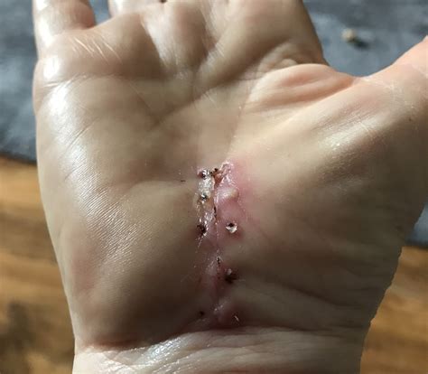 Carpal Tunnel Syndrome operation. My story. — Lupus Trust UK