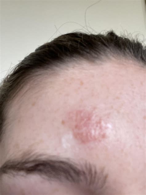 Staph Infection Scalp at Mary Spaulding blog
