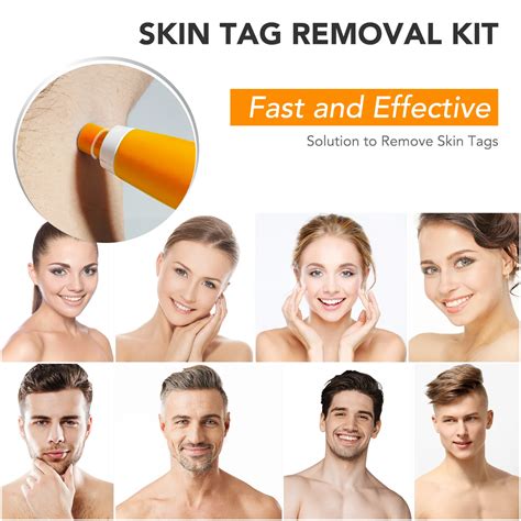 Skin Tag Remover – HOW DO I BUY THIS