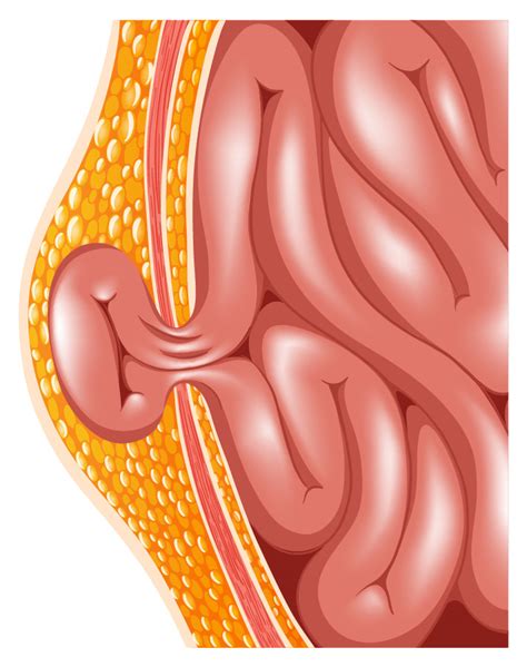 Hernia Repair: Current Diagnosis and Management for Abdominal Wall ...