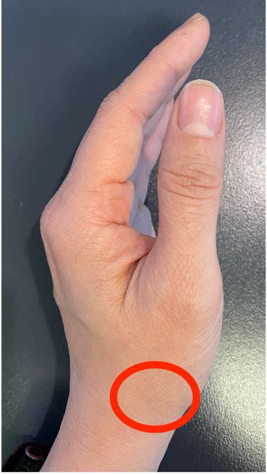 Scaphoid Fractures - Kinetic Orthopaedics