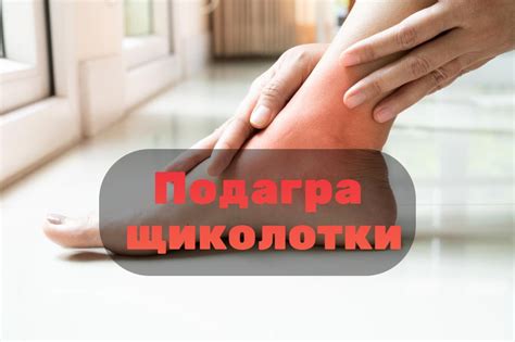 Подагра на щиколотке фото, симптомы и лечение подагры на щиколотке