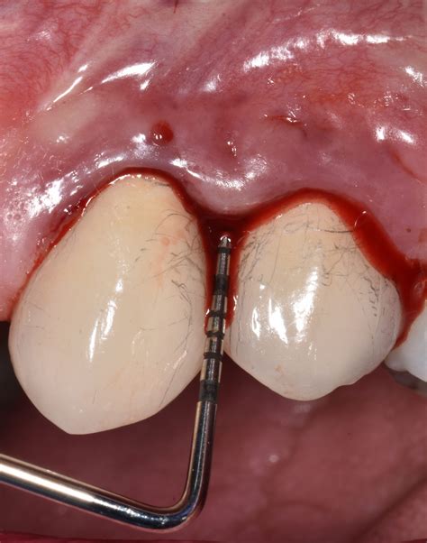 Periodontal Pocket Bleeding On Probing at Brodie Eldershaw blog