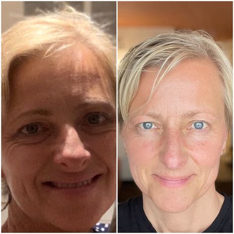 full face fibroblast before and after 8