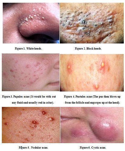 Papules And Pustules