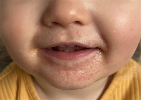 Rash around toddlers mouth | Mumsnet