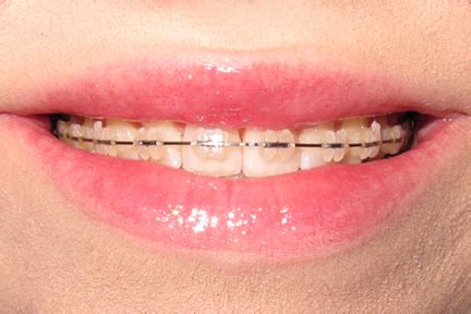 teeth braces before and after | Fischer Buzz