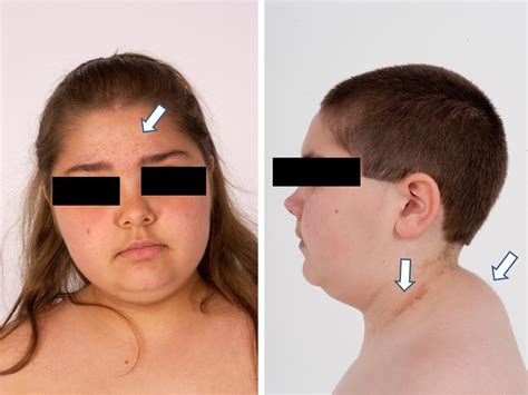 Cushing S Syndrome Young Woman at Julian Estabrook blog