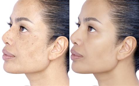 Neoskin Elite Skin Rejuvenation by Aerolase | The Facial Bar