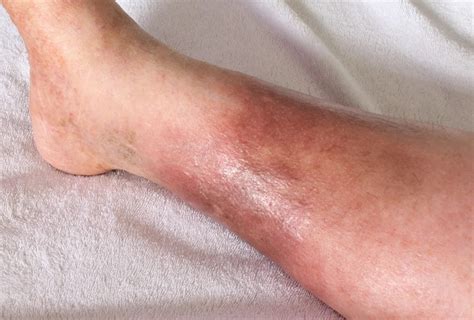 Leg Skin Discoloration Not a Dermatology Issue - Precision Vascular