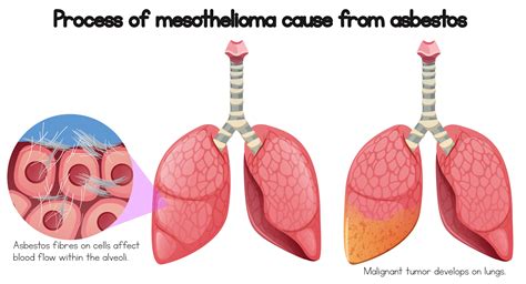 Process of mesothelioma cause of asbestos 614325 Vector Art at Vecteezy