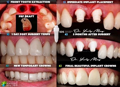 dental implant front tooth  nelson roberto blog