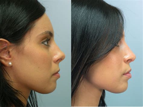 nose surgery cost  insurance dayle klinger